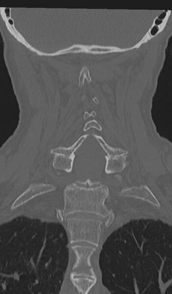 File:Acute on chronic subdural hematoma and thoracic vertebral injury in a multitrauma patient (Radiopaedia 31698-32619 Coronal bone window 40).jpg