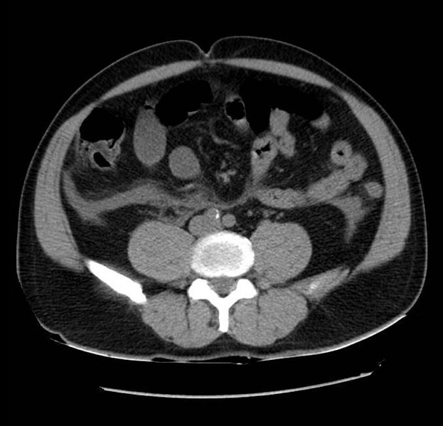 File:Acute pancreatitis - Balthazar E (Radiopaedia 23080-23110 Axial non-contrast 44).jpg