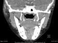 Acute parotitis (Radiopaedia 54123-60294 Coronal C+ arterial phase 1).jpg