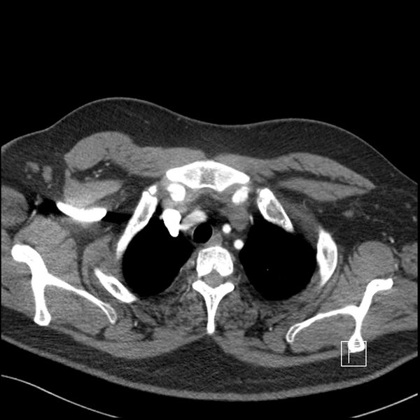 File:Acute pulmonary embolism with pulmonary infarct (Radiopaedia 73062-83768 Axial C+ CTPA 7).jpg
