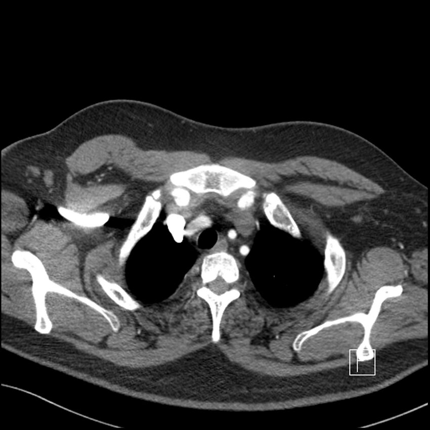 Acute pulmonary embolism with pulmonary infarct (Radiopaedia 73062-83768 Axial C+ CTPA 7).jpg
