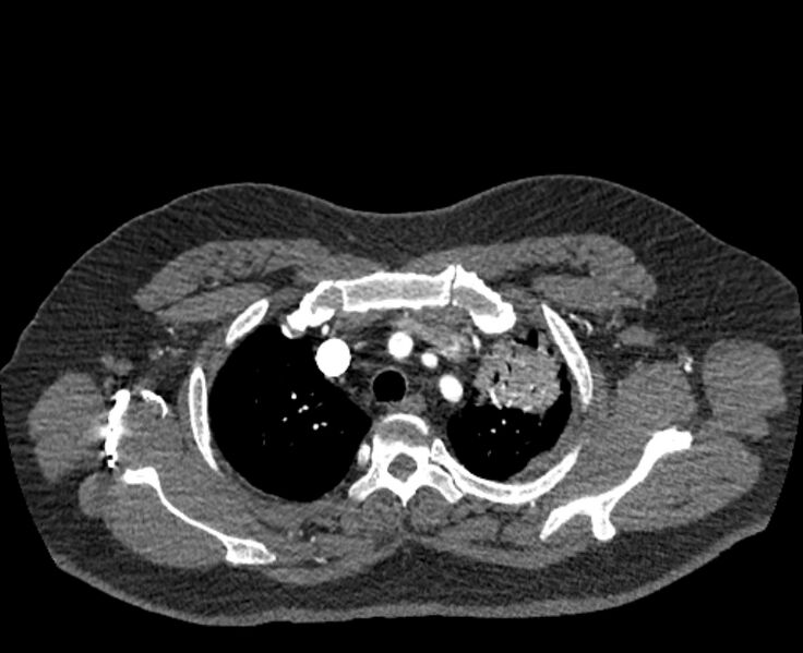 File:Acute pulmonary embolism with pulmonary infarcts (Radiopaedia 77688-89908 Axial C+ CTPA 8).jpg
