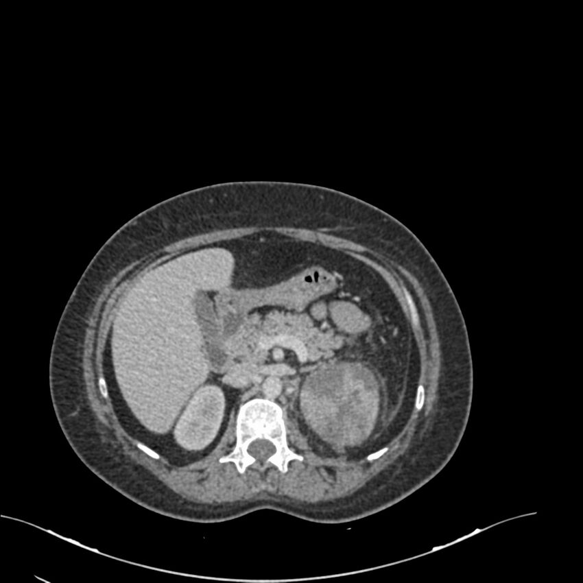 Acute pyelonephritis with renal vein thrombosis (Radiopaedia 58020-65053 Axial renal parenchymal phase 33).jpg