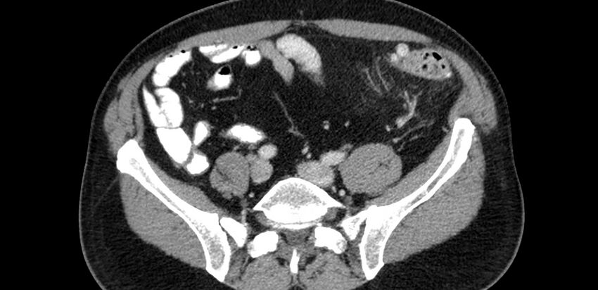 Acute sigmoid colon diverticulitis (Radiopaedia 55507-61976 Axial C+ portal venous phase 63).jpg