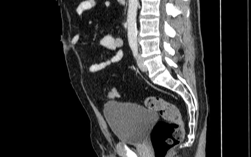 File:Acute sigmoid colon diverticulitis (Radiopaedia 55507-61976 Sagittal C+ portal venous phase 3).jpg