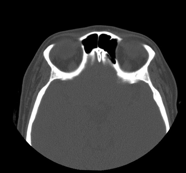 File:Acute sinusitis (Radiopaedia 22419-22455 Axial non-contrast 26).jpg