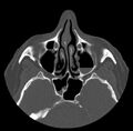 Acute sinusitis (Radiopaedia 23161-23215 Axial bone window 33).jpg