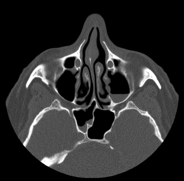 File:Acute sinusitis (Radiopaedia 23161-23215 Axial bone window 33).jpg
