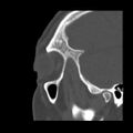 Acute sinusitis (Radiopaedia 23161-23215 Sagittal bone window 11).jpg