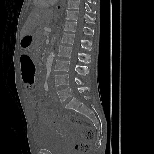 File:Acute vertebral body compression fractures (Radiopaedia 31757-32693 Sagittal bone window 25).jpg