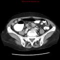 Adenocarcinoma of the colon (Radiopaedia 8191-9039 Axial liver window 51).jpg
