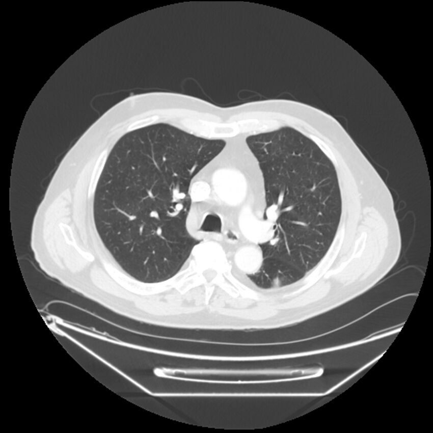 Adenocarcinoma of the lung (Radiopaedia 44876-48759 Axial lung window 29).jpg
