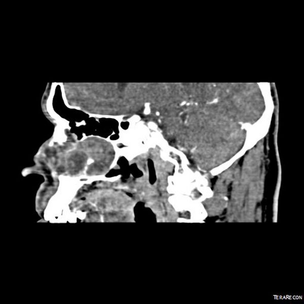 File:Adenoid cystic carcinoma involving paranasal sinus (Radiopaedia 16580-16283 Sagittal C+ arterial phase 6).jpeg