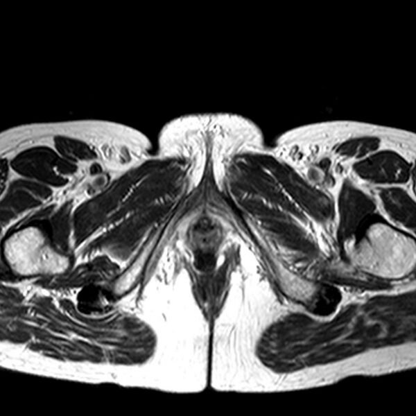 File:Adenomyoma of the uterus (huge) (Radiopaedia 9870-10438 Axial T2 1).jpg
