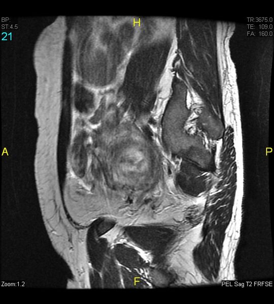 File:Adenomyosis (Radiopaedia 43504-46889 Sagittal T2 21).jpg