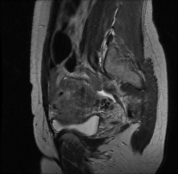 File:Adenomyosis on MRI (Radiopaedia 29328-29780 Sagittal T2 14).jpg