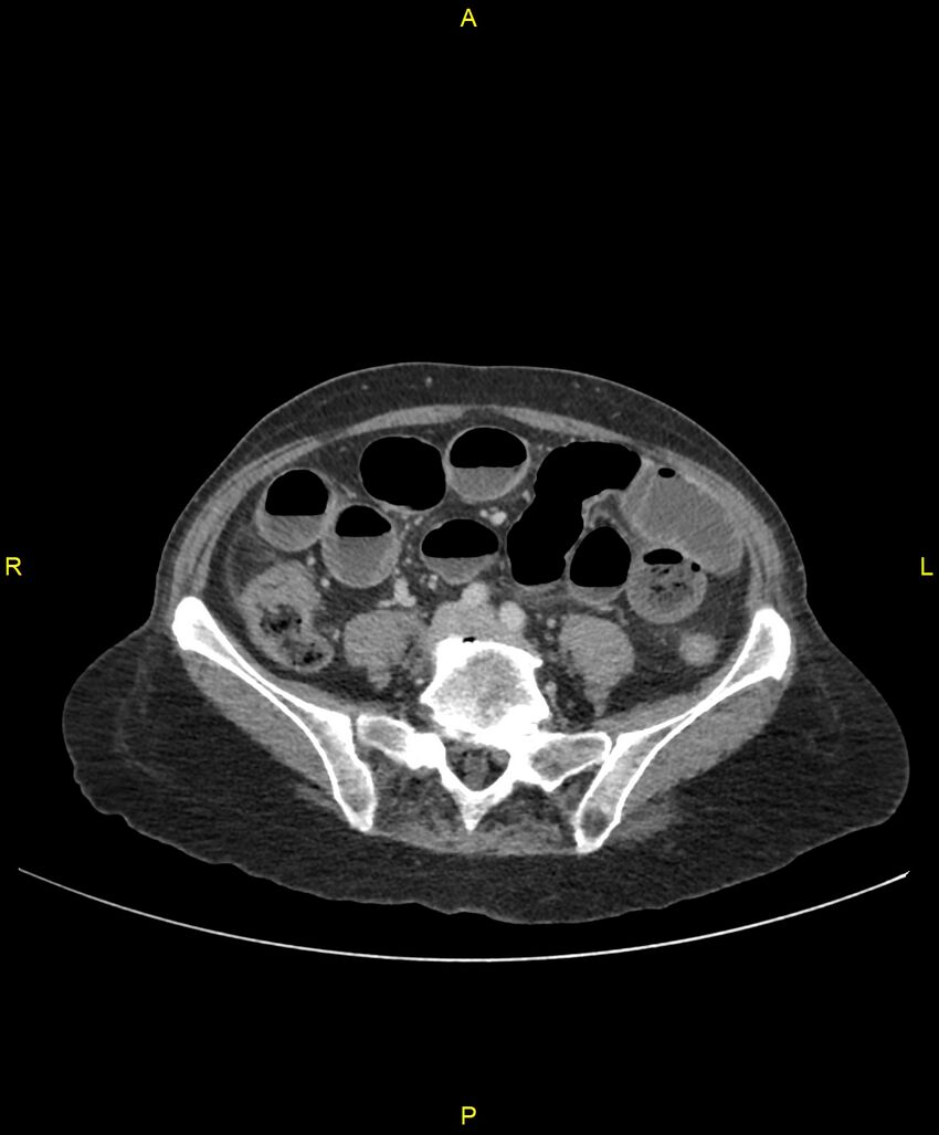 Adhesional small bowel obstruction (Radiopaedia 85402-101024 Axial C+ portal venous phase 187).jpg