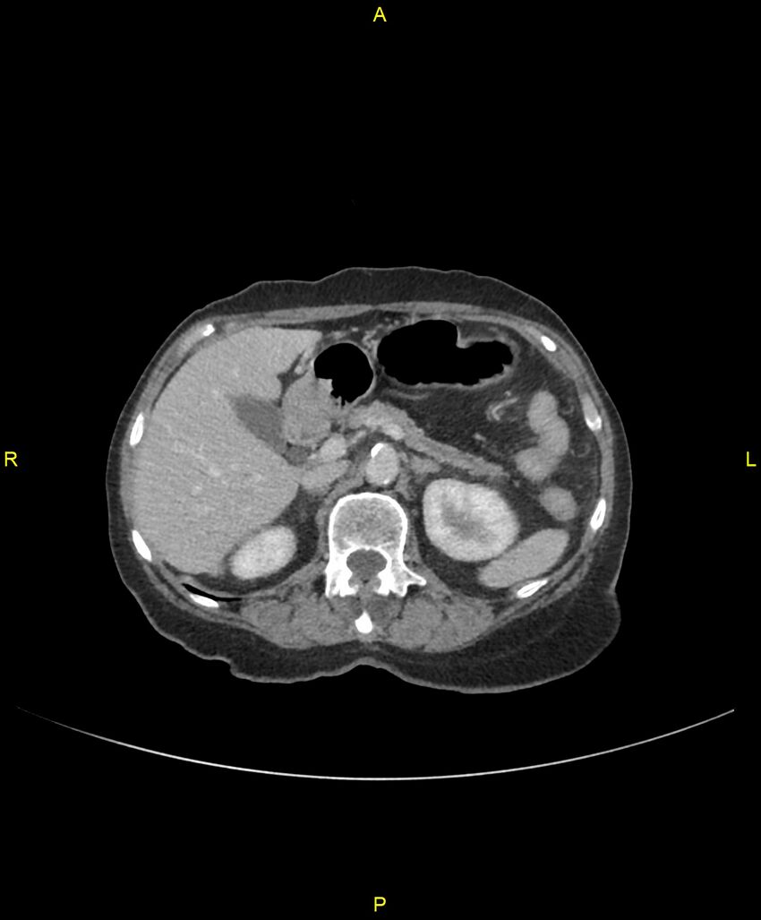 Adhesional small bowel obstruction (Radiopaedia 85402-101024 Axial C+ portal venous phase 86).jpg