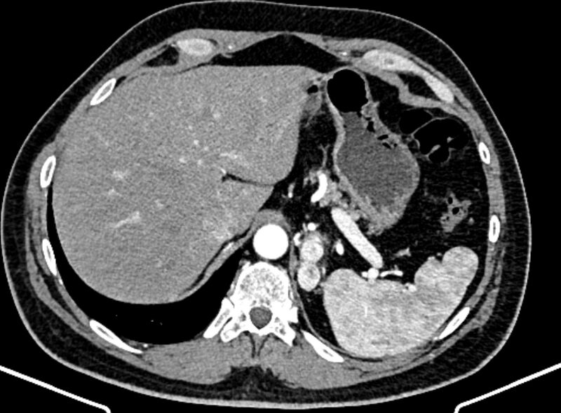 File:Adrenal metastases (Radiopaedia 73082-83791 Axial C+ arterial phase 32).jpg