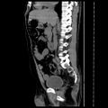 Adrenal myelolipoma (Radiopaedia 41843-44834 Sagittal non-contrast 21).jpg