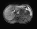 Adrenocortical carcinoma (Radiopaedia 11176-11541 E 1).jpg