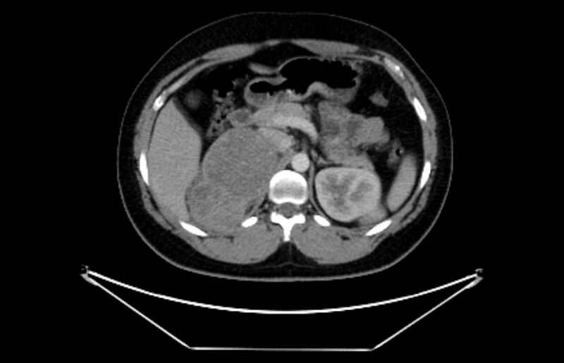 File:Adrenocortical carcinoma (Radiopaedia 80134-93438 Axial C+ portal venous phase 44).jpg