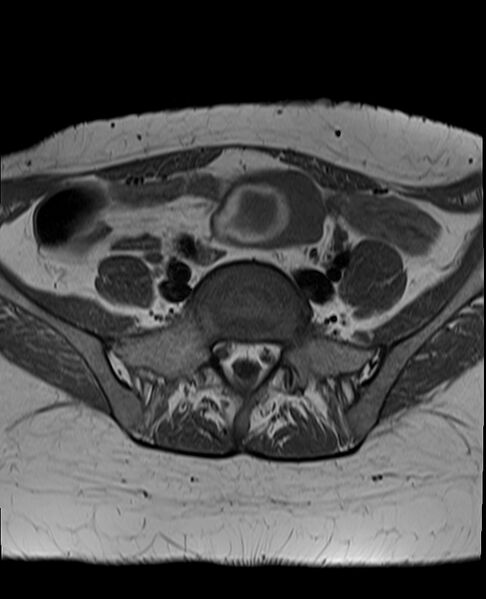 File:Adult granulosa cell tumor of the ovary (Radiopaedia 71581-81950 Axial T1 6).jpg