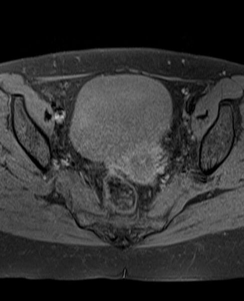 File:Adult granulosa cell tumor of the ovary (Radiopaedia 71581-81950 Axial T1 fat sat 15).jpg