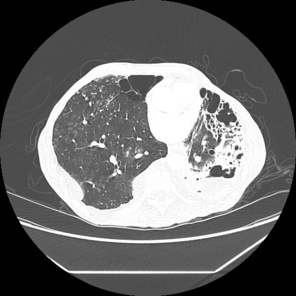 File:Advanced pulmonary tuberculosis (Radiopaedia 8599-9431 Axial lung window 34).jpg