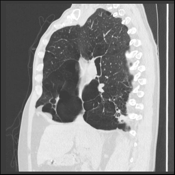 File:Alpha-1-antitrypsin deficiency (Radiopaedia 40993-43722 Sagittal lung window 157).jpg
