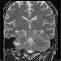 Amnestic syndrome secondary to hypoxic brain injury (Radiopaedia 24743-25004 F 5).jpg