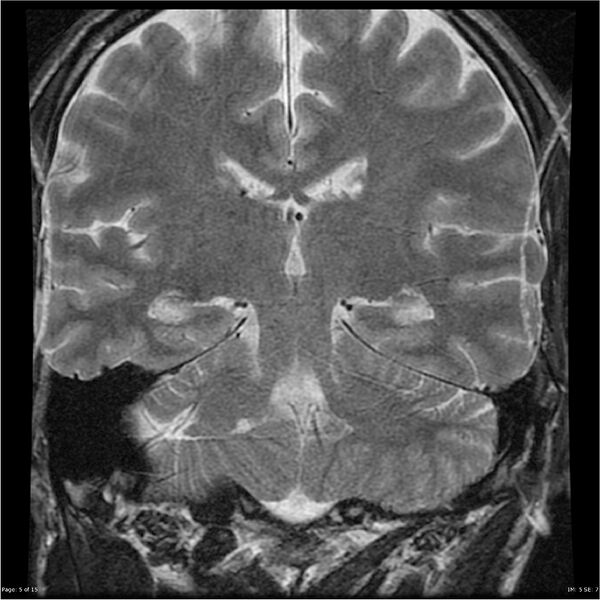 File:Amnestic syndrome secondary to hypoxic brain injury (Radiopaedia 24743-25004 F 5).jpg