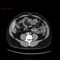 Ampullary carcinoma (Radiopaedia 56396-63056 C 60).jpg