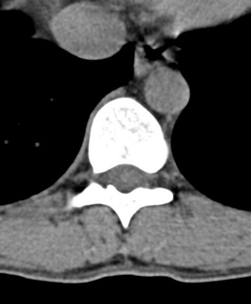 File:Aneurysmal bone cyst T11 (Radiopaedia 29294-29721 Axial non-contrast 34).jpg
