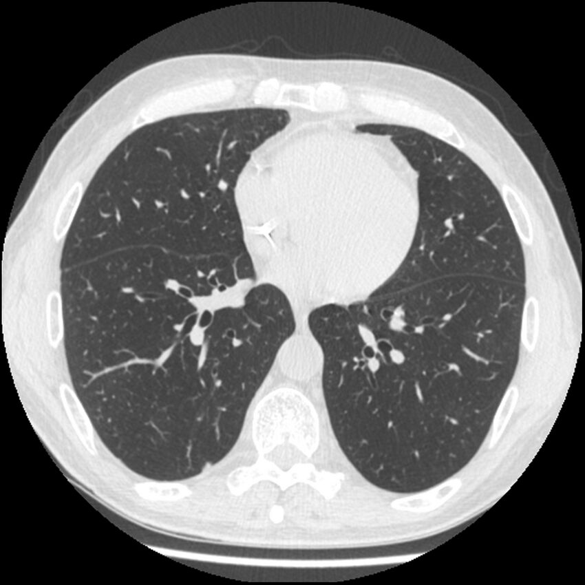 Angioinvasive aspergillosis (Radiopaedia 43957-47466 Axial lung window 43).jpg