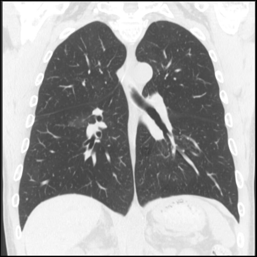 Angioinvasive aspergillosis (Radiopaedia 43957-47466 Coronal lung window 40).jpg