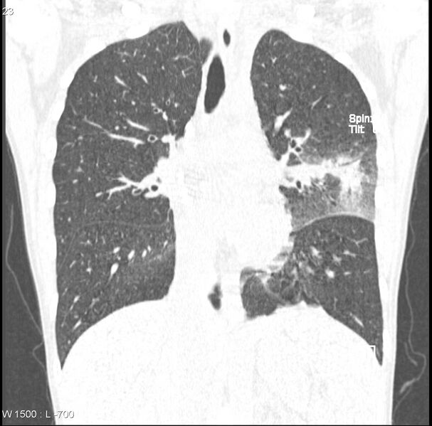 File:Angioinvasive aspergillosis (Radiopaedia 8651-9466 Coronal lung window 4).jpg
