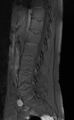 Ankylosing spondylitis - Andersson lesion (Radiopaedia 81878-95838 Sagittal T1 fat sat 5).jpg