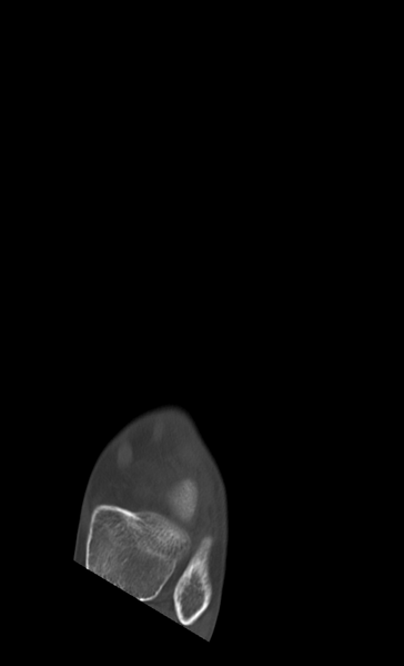 File:Anterior calcaneal process fracture (Radiopaedia 47384-51989 Axial bone window 6).png