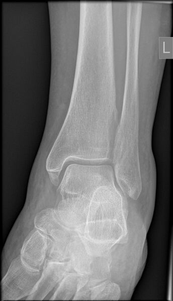 File:Anterior calcaneal process fracture (Radiopaedia 63353-71942 Oblique 1).jpg