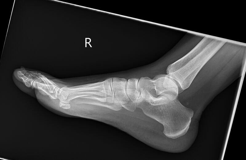 File:Anterior calcaneal process fracture (Radiopaedia 82590-96764 Lateral 1).jpg