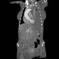 Aortic dissection (Radiopaedia 68763-78691 B 9).jpeg