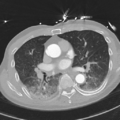 Aortic dissection - DeBakey type II (Radiopaedia 64302-73082 Axial lung window 31).png
