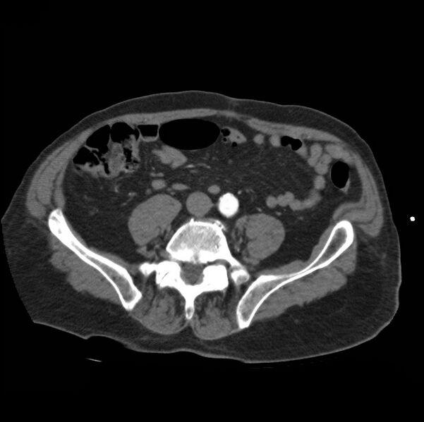 File:Aortic dissection with rupture into pericardium (Radiopaedia 12384-12647 A 72).jpg