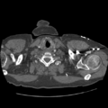 Aorto-coronary bypass graft aneurysms (Radiopaedia 40562-43157 A 9).png