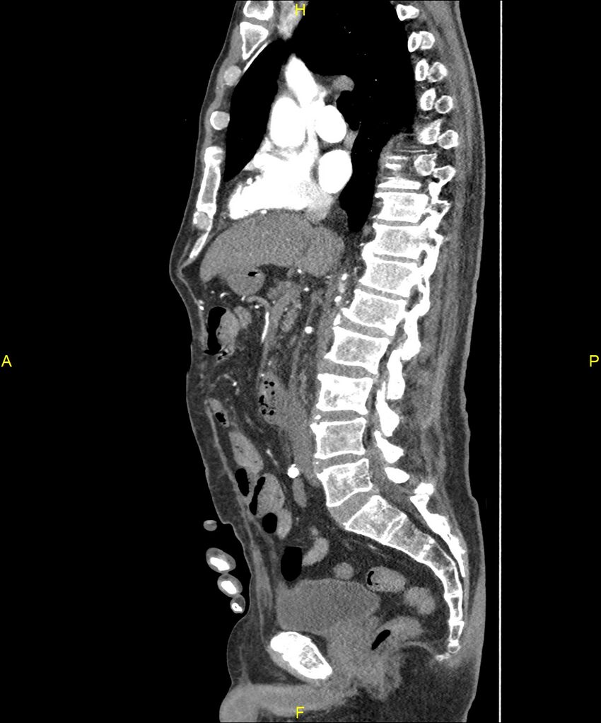 Aortoenteric fistula (Radiopaedia 84308-99603 C 164).jpg