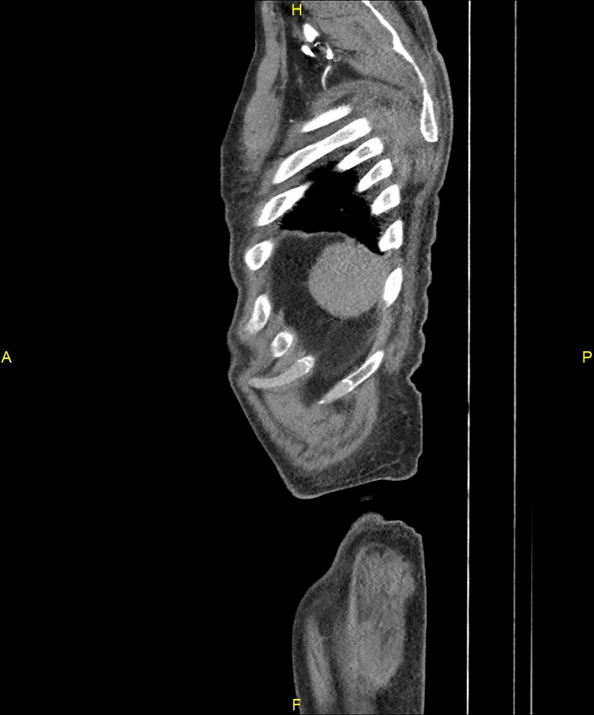 Aortoenteric fistula (Radiopaedia 84308-99603 C 317).jpg