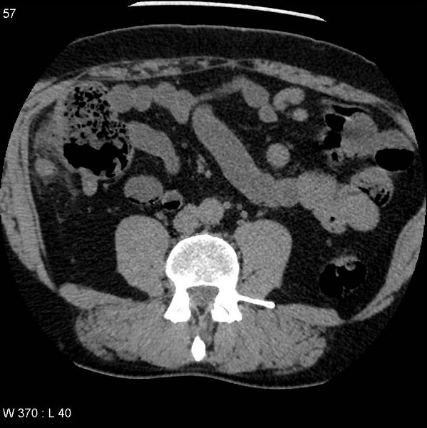 File:Appendicitis (Radiopaedia 12510-12733 Axial non-contrast 24).jpg