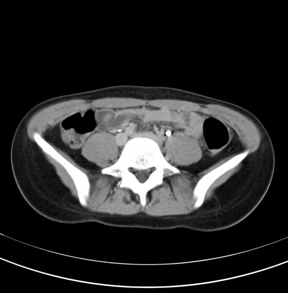 File:Appendicitis and incidental bicornuate uterus (Radiopaedia 22833-22853 Axial C+ delayed 24).jpg