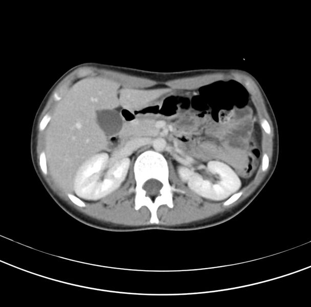 File:Appendicitis and incidental bicornuate uterus (Radiopaedia 22833-22853 B 14).jpg
